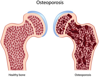 Osteoporosis Coding in 2015 – An Overview